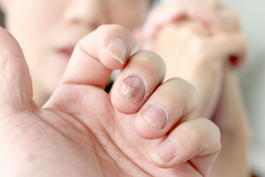 Schuppenflechte (Psoriasis) an den Nägeln Ursachen & Behandlung